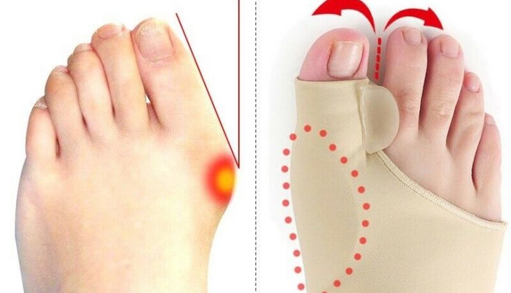 Sizable Toe Splint Straightener Corrector Bunion Hallux Valgus Nervousness Support Feet Care
